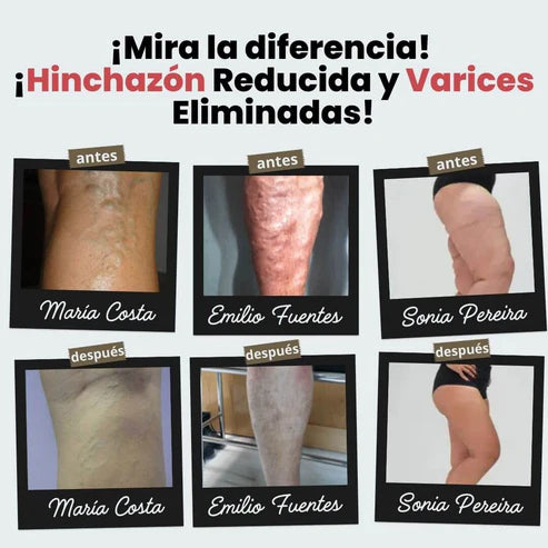 (¡Llévate 2 pares por el precio de 1!) Calcetines de Acupresión Anti-Várices